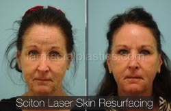 Laser Skin Resurfacing Before & After