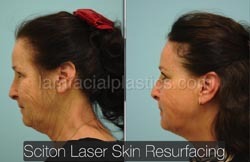 Laser Skin Resurfacing Before & After