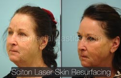 Laser Skin Resurfacing Before & After