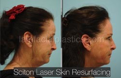 Laser Skin Resurfacing Before & After