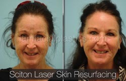 Laser Skin Resurfacing Before & After
