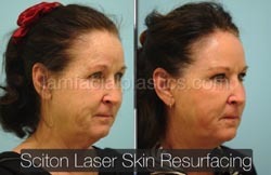 Laser Skin Resurfacing Before & After