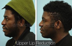 Lip Reduction Before & After