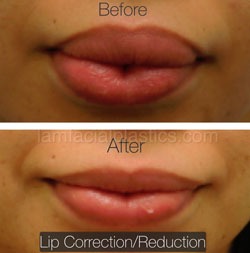 Lip Reduction Before & After