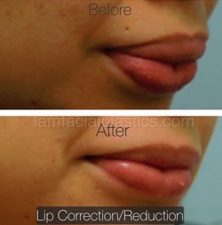 Lip Reduction Before & After