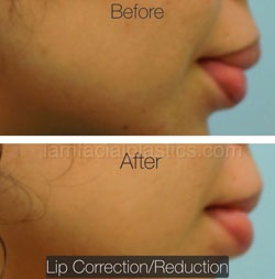 Lip Reduction Before & After