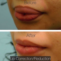 Lip Reduction Before & After