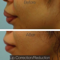 Lip Reduction Before & After