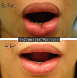 Lip Reduction Before & After