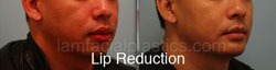 Lip Reduction Before & After