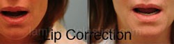Lip Reduction Before & After