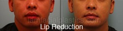 Lip Reduction Before & After