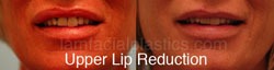 Lip Reduction Before & After