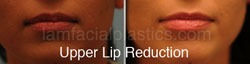 Lip Reduction Before & After