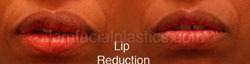 Lip Reduction Before & After
