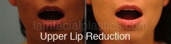 Lip Reduction Before & After