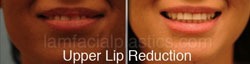 Lip Reduction Before & After