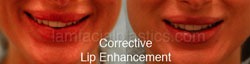 Lip Reduction Before & After