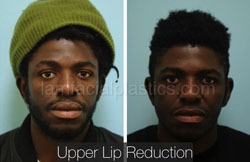 Lip Reduction Before & After