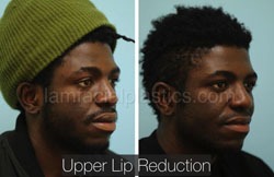 Lip Reduction Before & After