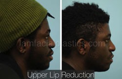 Lip Reduction Before & After