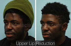 Lip Reduction Before & After