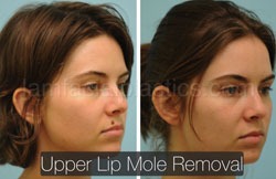 Mole Removal Before & After
