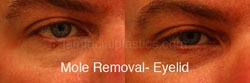 Mole Removal Before & After