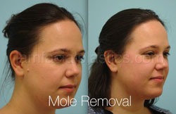 Mole Removal Before & After