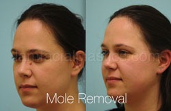 Mole Removal Before & After