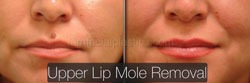 Mole Removal Before & After