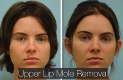 Mole Removal Before & After
