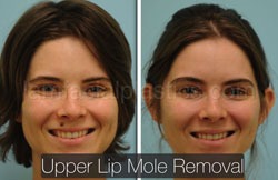 Mole Removal Before & After