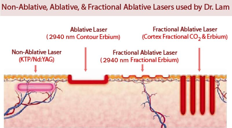 Laser Skin Resurfacing