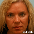 Image of a Skin Resurfacing patient