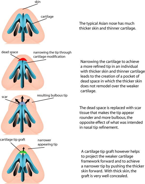 Asian Rhinoplasty