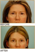 Brow Lift Surgery Dallas TX