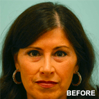 Image of a Brow Lift patient