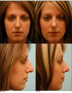 caucasian_rhinoplasty