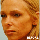 Image of a Cheek Augmentation patient