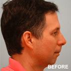 Image of a Chin Augmentation patient