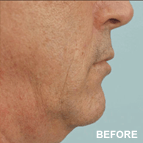 Image of a Facelift patient