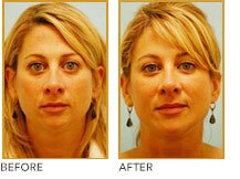 juvederm