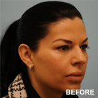 Image of a Lip Procedures patient
