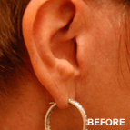 Image of a Mini Facelift/Mini Lift patient
