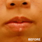 Image of a Mole Removal patient