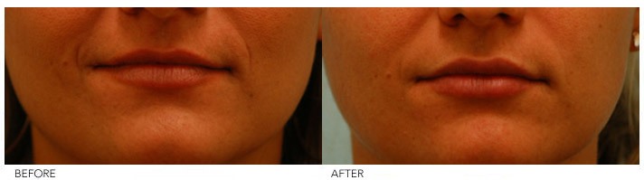 Lip Procedures