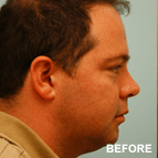 Image of a Neck Liposuction patient