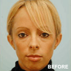 Image of a Otoplasty patient