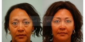 Facial Fat Transfer